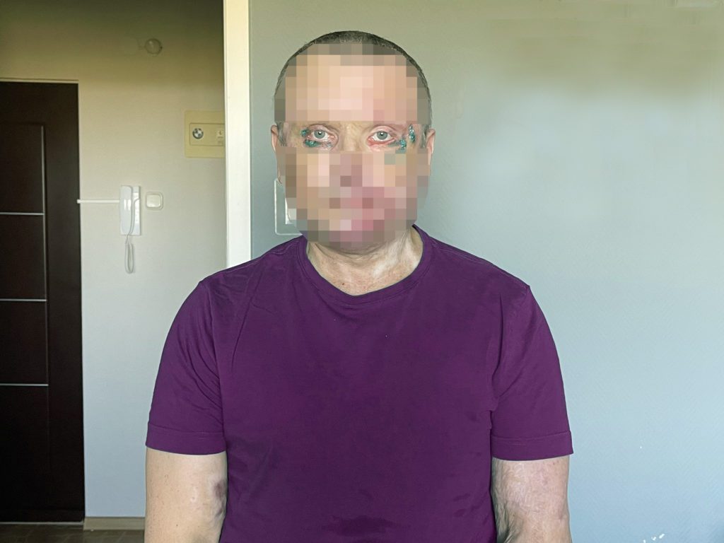 55-летний волгоградец после страшного ДТП привыкает жить с новым лицом